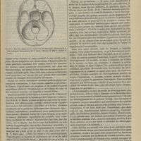 1181 - Page 1169 - Revue générale. L'acromégalie. Par M. le Docteur Georges Guinon... VII. Anatomie pathologique / VIII. Nature et pathogénie