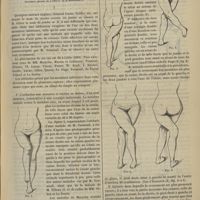 0191 - Page 191 - Revue générale. Des jambes en ciseaux consécutives aux affections de la hanche, coxalgie, etc. Par le Docteur L.-H. Petit... I