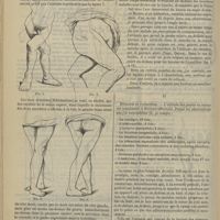 0192 - Page 192 - Revue générale. Des jambes en ciseaux consécutives aux affections de la hanche, coxalgie, etc. Par le Docteur L.-H. Petit... I / II. Étiologie et pathogénie