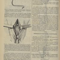 0474 - Page 502 - Revue générale. La symphyséotomie. Par le Docteur P.-A. Lop... Chapitre II. La symphyse des pubis et ses rapports. (A suivre) / Chronique et nouvelles scientifiques