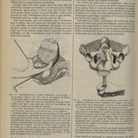 0782 - Page 810 - Revue générale. Description et mode d'emploi du préhenseur-levier-mensurateur. Par M. le Professeur L.-H. Farabeuf. III. Choix de la main-guide ; application du guide-redresseur ; redressement / IV. Introduction de la cuillère postérieure