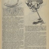 0783 - Page 811 - Revue générale. Description et mode d'emploi du préhenseur-levier-mensurateur. Par M. le Professeur L.-H. Farabeuf. IV. Introduction de la cuillère postérieure / V. Introduction et placement de la cuillère antérieure