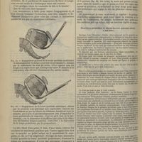0786 - Page 814 - Revue générale. Description et mode d'emploi du préhenseur-levier-mensurateur. Par M. le Professeur L.-H. Farabeuf. VII. Engagement et descente / Exercices préalables et objets inertes pouvant servir à les faire