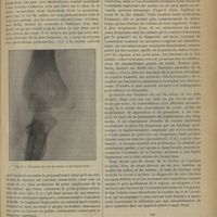 0277 - Page 267 - Revue générale. Les fractures du coude, en particulier chez les jeunes sujets. Par le Docteur Albert Mouchet... II. Fractures des os de l'avant-bras / III. Fractures de l'extrémité inférieure de l'humérus