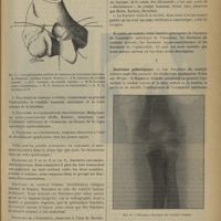 0279 - Page 269 - Revue générale. Les fractures du coude, en particulier chez les jeunes sujets. Par le Docteur Albert Mouchet... IV. Classification / V. Anatomie pathologique