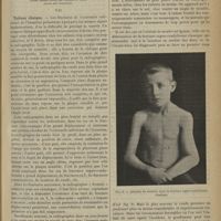 0305 - Page 295 - Revue générale. Les fractures du coude, en particulier chez les jeunes sujets. Par le Docteur Albert Mouchet... VII. Tableau clinique