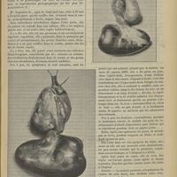 0489 - Page 483 - Un cas de salpingite à pédicule tordu ; par M. A. Ricard...