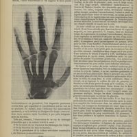 0916 - Page 910 - Fracture oblique et transversale de l'extrémité inférieure de la phalange de l'index gauche ; par M. Estrabaut... / Le nouveau-né
