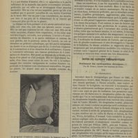 1590 - Page 1584 - Tumeur polypiforme du sein ; par M. Pommerol... / Notes de clinique thérapeutique. Traitement des cardiopathies chroniques ; par M. Guihal...