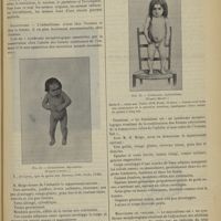 0045 - Page 39 - Revue générale. Les stigmatiques anatomiques de la dégénérescence. Par M. Lucien Mayet... Malformations ano-rectales / Infantilisme / Féminisme / Masculisme ou virilisme