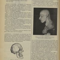 0046 - Page 40 - Revue générale. Les stigmatiques anatomiques de la dégénérescence. Par M. Lucien Mayet... Masculisme ou virilisme / Nanisme et gigantisme / Acromégalie