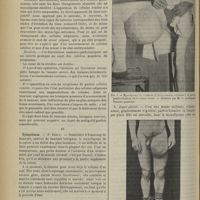 0686 - Page 688 - Revue générale. Les myxolipomes de la cuisse. Par MM. L. Thévenot... et M. Patel... III. Anatomie pathologique / IV. Symptômes