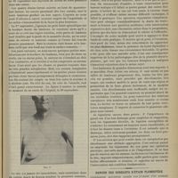 1209 - Page 1211 - Sarcome du sein coïncidant avec un goitre volumineux. Autoplastie de la plaie thoracique à l’aide des téguments du cou après extirpation du goitre ; par H. Morestin... / Danger des gobelets d’étain plombifère. Intoxication saturnine causée par l’usage d’un gobelet d’étain chez un enfant de quatre ans et demi ; par M. G. Variot...