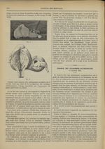 [Utérus bifide. Fibrome à droite, grossesse à gauche, hystérectomie abdominale. Guérison] - Gazette  [...]