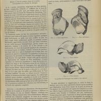 0409 - Page 399 - Fracture et luxation de l'astragale. Astragalectomie partielle. Guérison ; par le Docteur Couteaud...