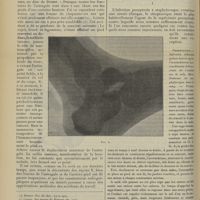 0410 - Page 400 - Fracture et luxation de l'astragale. Astragalectomie partielle. Guérison ; par le Docteur Couteaud... / Avis / Infection puerpérale à « staphylocoque » ; par le Docteur Lop...