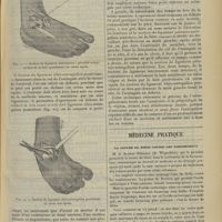 0607 - Page 597 - Technique de l'extirpation de l'astragale ; par L. Chevrier... / Médecine pratique. La levure de bière contre les vomissements