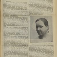 0745 - Page 735 - Clinique chirurgicale de l'Hôtel-Dieu de Lyon. Actinomycose et grossesse ; par M. le Professeur Antonin Poncet