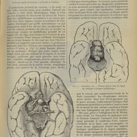 1069 - Page 1059 - L'épithélioma primitif du cerveau ; par le Docteur Raymond Cestan...