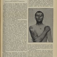 1165 - Page 1155 - Clinique chirurgicale. Neurofibromatose avec névrome plexiforme ; par M. Jaboulay...