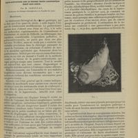 1237 - Page 1227 - Clinique chirurgicale. Traitement chirurgical du cancer gastrique. Résection totale de l'estomac. Gastro-entérostomie avec un nouveau bouton anastomotique tenant sans suture. Par M. Jaboulay...