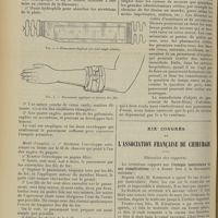 1432 - Page 1422 - Un pansement de chirurgie d'urgence ; par le Docteur Jean Cavalier... / XIXe Congrès de l'association française de chirurgie. Discussion des rapports. Ectopie testiculaire et ses complications. M. Kirmisson