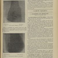 1469 - Page 1459 - Amputation ostéo-plastique fémoro-rotulienne de Gritti avec suture métallique des deux os. Nouvelle série de cinq cas personnels. Guérison. Marche sur le bout du moignon ; par le Docteur S. Szczypiorski... / Sociétés savantes. Académie de médecine. (Séance du 23 octobre 1906). La suette miliaire et le rat des champs. M. Chantemesse / Un traitement du cancer. M. Adamkiewicz...