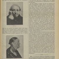 1743 - Page 1733 - Clinique chirurgicale. Tumeur mixte de la parotide ; par M. Jaboulay... / Avis