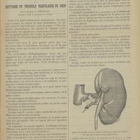 0085 - Page 75 - Clinique chirurgicale. (Hôtel-Dieu de Lyon. M. le Professeur A. Poncet). Plaies et ruptures du pédicule vasculaire du rein ; par le Docteur L. Thévenot...