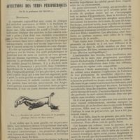 0145 - Page 135 - Clinique des maladies nerveuses. (Leçons du mardi de la Salpêtrière). Sur quelques affections des nerfs périphériques ; par M. le Professeur Raymond
