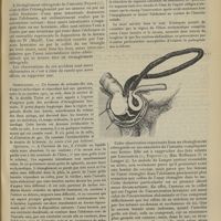 0285 - Page 279 - Hernie compliquée d'étranglement rétrograde de l'intestin ; par L. Laroyenne...