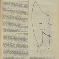 0441 - Page 435 - Application des différentes méthodes d'amputation des membres ; par A. Mignon...