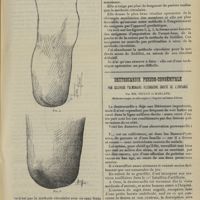 0443 - Page 437 - Application des différentes méthodes d'amputation des membres ; par A. Mignon... / Dextrocardie pseudo-congénitale par sclérose pulmonaire pleurogène droite de l'enfance ; par MM. Niclot et Marland...