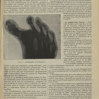0575 - Page 569 - A propos d'un cas de luxation des gros orteils en dedans ; par M. Sénéchal... / Sociétés savantes. Académie de médecine. (Séance du 23 avril 1907). La syphilis dans l'armée. M. Delorme
