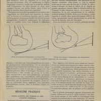 0827 - Page 821 - Tuberculose du pieds. Amputation sous-astragalienne. Amputation sus-calcanéenne ; par M. Jaboulay... / Médecine pratique. Signes cliniques des tumeurs du rein d'origine surrénale. [A. Gaullieur l'Hardy]