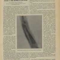 0873 - Page 867 - Ostéite tuberculeuse de la diaphyse radiale affectant la forme anatomique du Spina Ventosa ; par le Docteur Georges Leclerc...