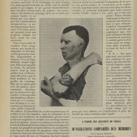 1042 - Page 1036 - Dégénérescence cancroïdale des brûlures (et des lésions syphilitiques) ; par M. Jaboulay... / A propos des accidents du travail. Mensurations comparées des membres ; par le Docteur Masini...