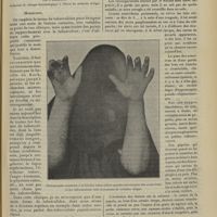 1065 - Page 1059 - Clinique dermatologique. Tuberculides papulo-nécrotiques ; par J. Brault...