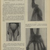 1353 - Page 1347 - Ankylose de la hanche et main bote par ostéomyélite ; par M. Jaboulay...