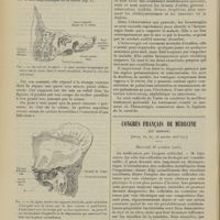1486 - Page 1480 - Otite ; méningite cérébro-spinale. Ulcération de la carotide. Chez un diabétique. Hémorragie. Mort ; par M. F. Labouré... / Congrès français de médecine. (IXe session). [Paris, 14, 15, 16 octobre 1907]. Mercredi 16 octobre (soir). La médication par l'argent colloïdal. M. Iscovesco