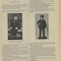 1581 - Page 1575 - Clinique chirurgicale de l'Hôtel-Dieu de Lyon. (M. le Professeur A. Poncet). Un cas de nanisme thyroïdien ; par Joseph Chalier