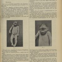 0075 - Page 63 - Clinique obstétricale. Un cas de cyclopie ; par M. Roland...