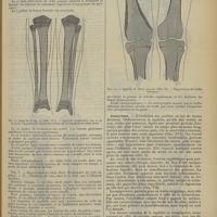 0579 - Page 571 - Revue générale. Contribution à l'étude clinique et radiographique de la syphilis héréditaire des os longs ; par MM. V. Ménard..., Fr. Le Moine et J. Pénard... Étude clinique / Évolution