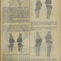 0611 - Page 603 - Revue générale. Contribution à l'étude clinique et radiographique de la syphilis héréditaire des os longs ; par MM. V. Ménard... Fr. Le Moine et J. Pénard... Complications