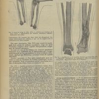 0614 - Page 606 - Revue générale. Contribution à l'étude clinique et radiographique de la syphilis héréditaire des os longs ; par MM. V. Ménard... Fr. Le Moine et J. Pénard... Complications / Étude radiographique