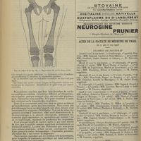 0618 - Page 610 - Revue générale. Contribution à l'étude clinique et radiographique de la syphilis héréditaire des os longs ; par MM. V. Ménard... Fr. Le Moine et J. Pénard... Traitement / Sociétés savantes. Société de chirurgie. (Séance du 29 avril 1908) / Actes de la Faculté de médecine de Paris du 11 au 16 mai 1908. Examens de doctorat