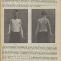 1403 - Page 1407 - Raccourcissement de l'humérus par résection de l'épaule pratiquée en bas âge ; par le Docteur Broca