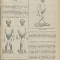 1499 - Page 1503 - La coxalgie double. [Étude clinique et thérapeutique] ; par MM. Guillaume-Louis... et J. Calvé...