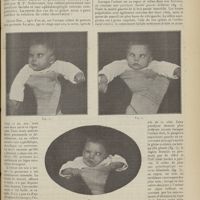 1511 - Page 1515 - Paralysie faciale unilatérale et ophatlmoplégie externe bilatérale congénitales ; par MM. L. Babonneix et P. Harvier