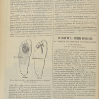 0414 - Page 408 - Trois cas de mal perforant plantaire traités par l'élongation nerveuse. Guérison sans récidive actuelle ; par le Docteur Lop... / Le signe de la détente musculaire. Sa valeur en clinique psychologique ; par M. Bérillon...